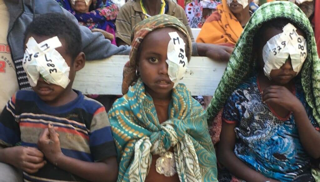 Children after cataract surgery